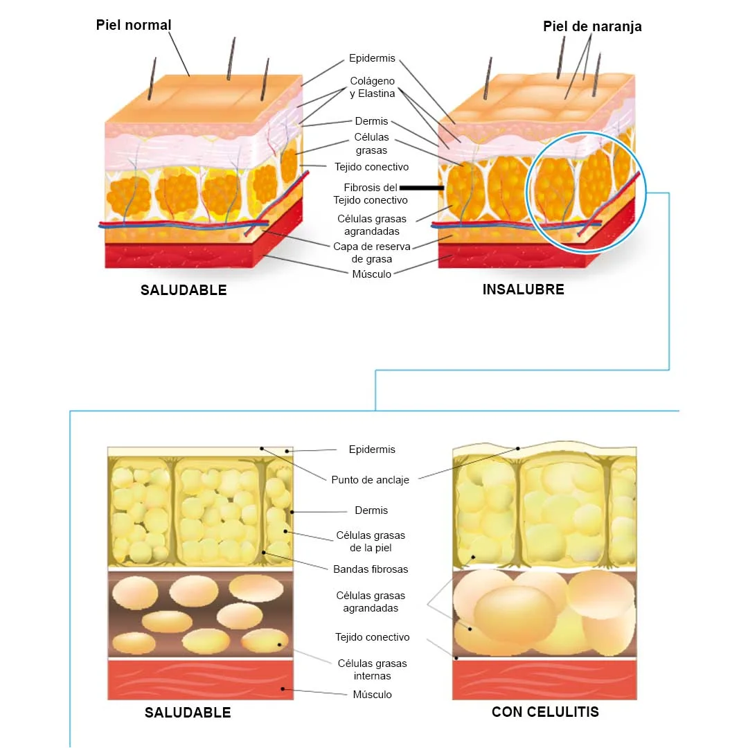 capas de la piel con celulitis